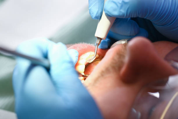 Best Dental Abscess Treatment in Church Hill, TN